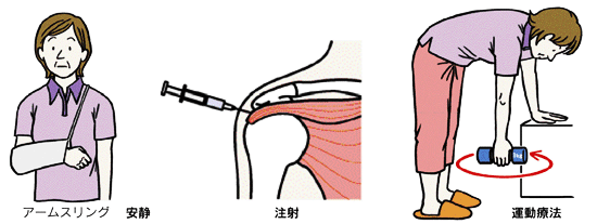 山形県のおやま整形外科クリニックの五十肩に関する治療方法イラスト