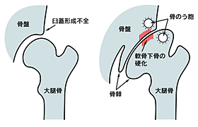 山形県のおやま整形外科クリニックの股関節イメージイラスト