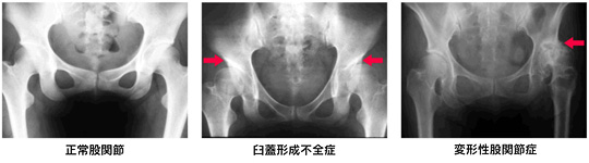 山形県のおやま整形外科クリニックの股関節のレントゲンイメージ