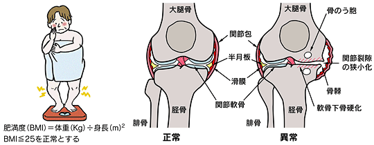 山形県のおやま整形外科クリニックの変形性膝関節症のイメージイラスト