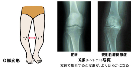 山形県のおやま整形外科クリニックの変形性膝関節症のレントゲン