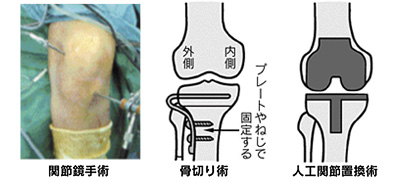 山形県のおやま整形外科クリニックの変形性膝関節症治療で使用する人工関節イメージ