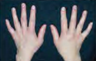 山形県のおやま整形外科クリニックの手の膨張と変形の写真