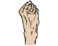 山形県のおやま整形外科クリニックの足のリウマチ参考写真