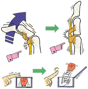 山形県のおやま整形外科クリニックのばね指具体的イメージイラスト