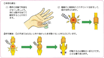 山形県のおやま整形外科クリニックのばね指治療イメージイラスト