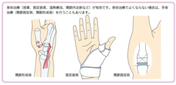 山形県のおやま整形外科クリニックの母指CM関節症の治療イメージイラスト