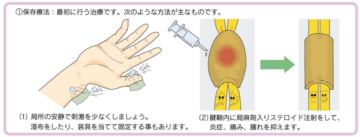 山形県のおやま整形外科クリニックの腱鞘炎への注射イメージイラスト