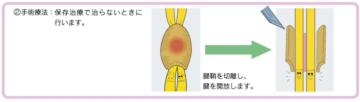 山形県のおやま整形外科クリニックの腱鞘炎の神経イメージイラスト